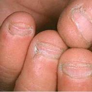Почему нельзя грызть ногти Почему нельзя грызть ногти