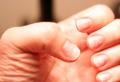 Psoriazisul unghiilor: manifestări ale bolii și tratament